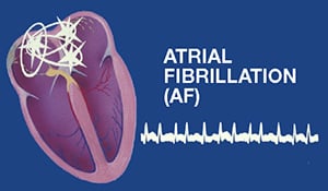 Atrial Fibrillation | Army Aviation Magazine