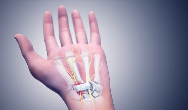 Carpal Tunnel: Symptoms & Treatments - Neurology Office Joseph